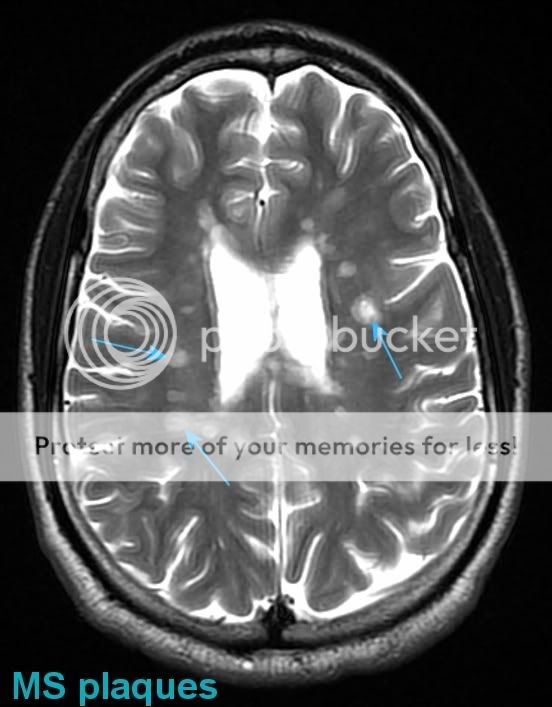 MS MRI Plaque Photo by neurologycoffeecup Photobucket
